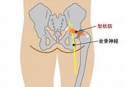 江南市　整体　坐骨神経痛