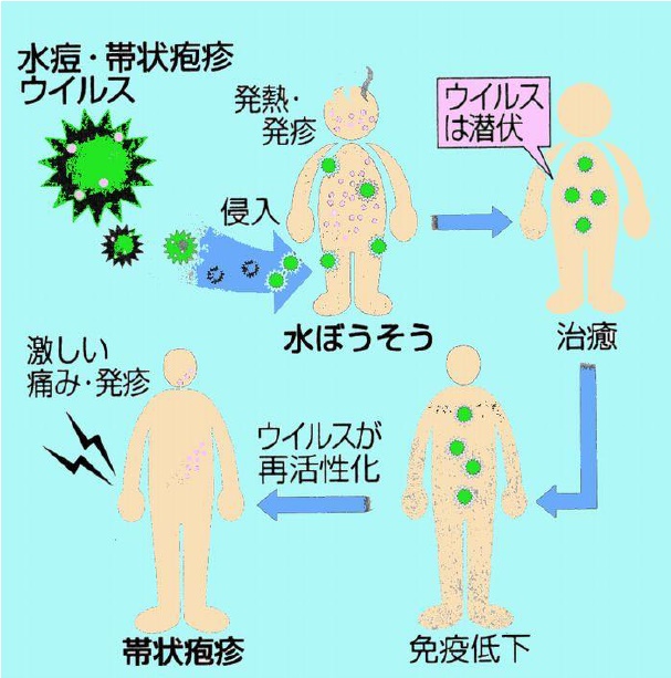 江南市　整体　帯状疱疹後神経痛